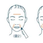 「リンクルショット」で ほうれい線に挑戦!シワの深さが浅くなっている